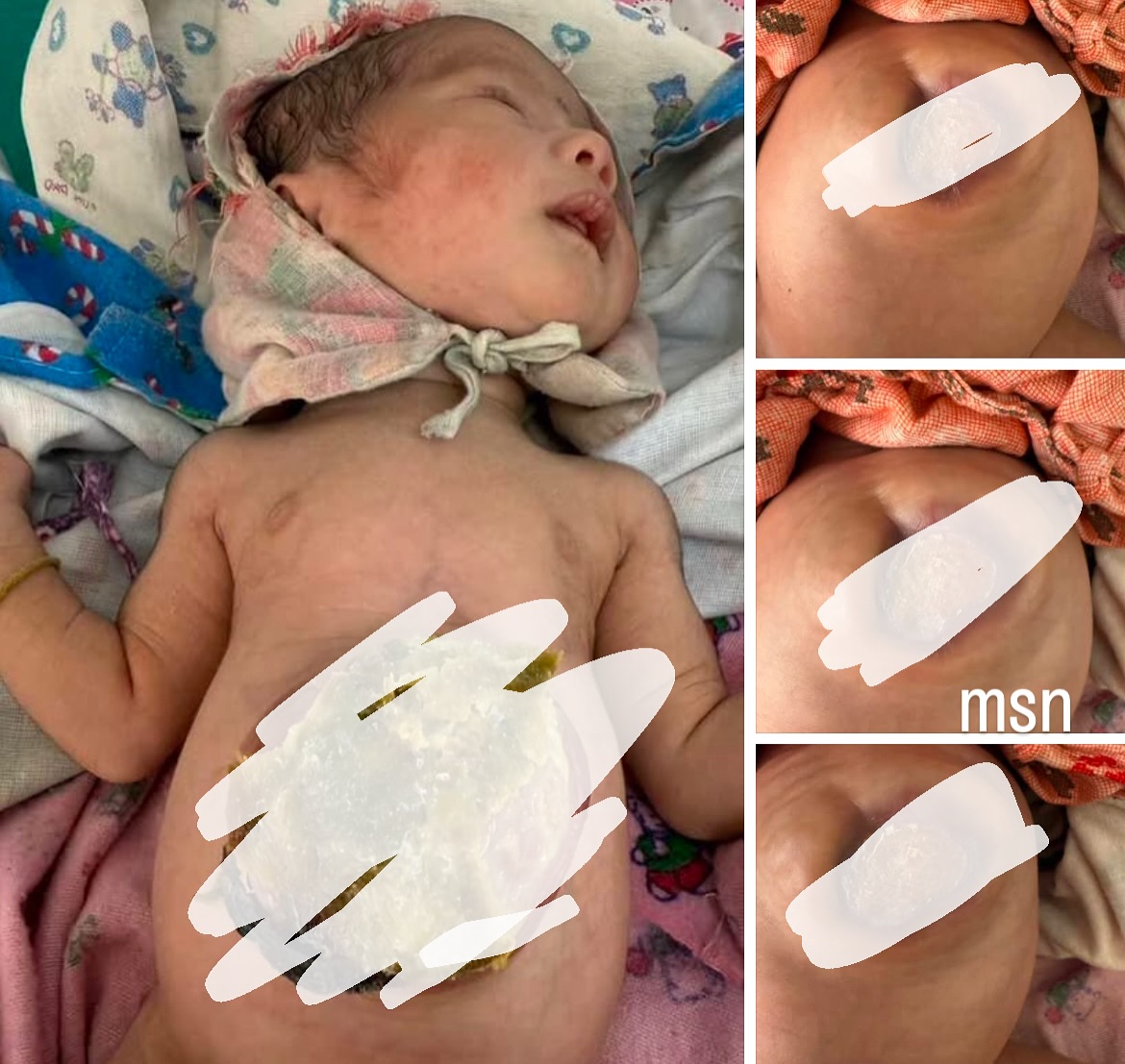 ख्वप अस्पतालद्वारा नवजात शिशुको दुर्लभ रोगको निःशुल्क उपचार